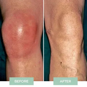 Knee Massager – Knee Pain Relief Device